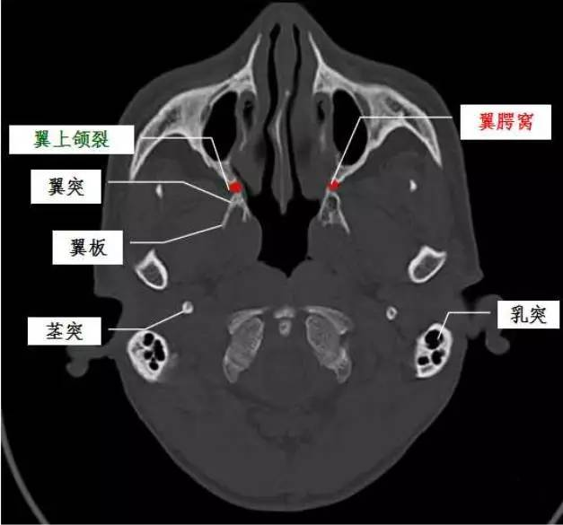 翼腭窝的ct影像解剖