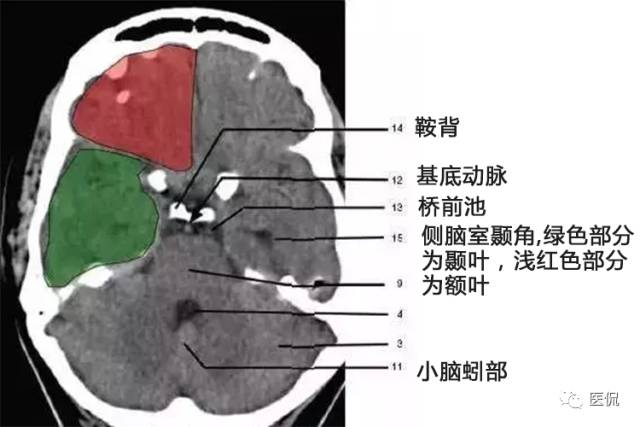 颅脑ct解剖口诀