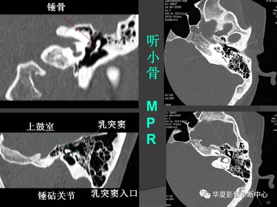 颞骨断层解剖及ct三维重建