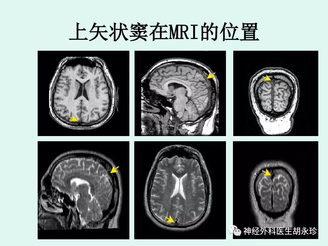 (1)上矢状窦:位于大脑镰的上缘,主要接受来自大脑上静脉分支,颅骨板障