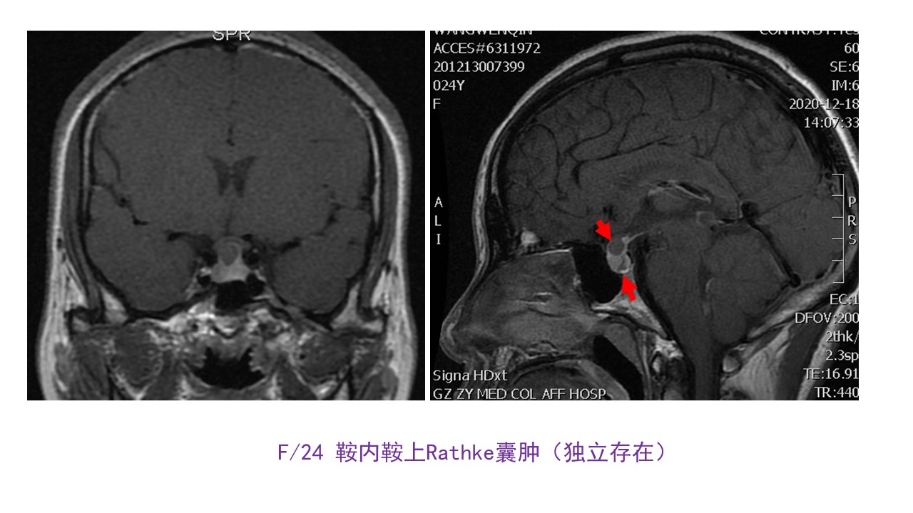 肖顺武教授内镜扩大经鼻经鞍结节入路切除鞍上拉克氏rathkes囊肿