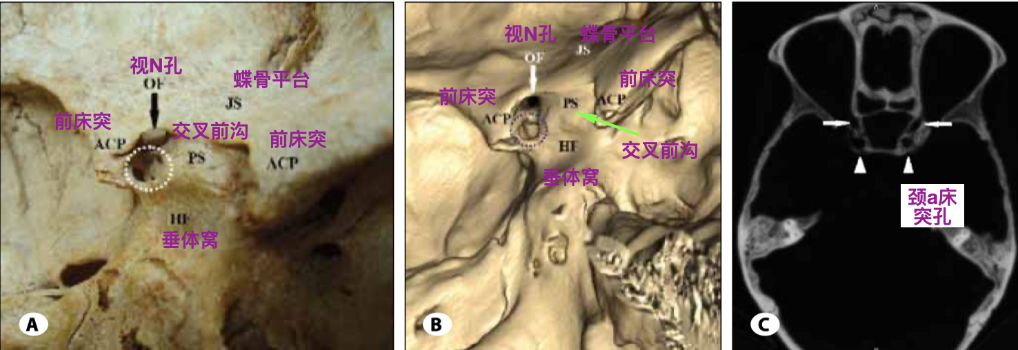 中床突(middle clinoid process)在蝶鞍的前外侧缘发自蝶骨体部,是颈
