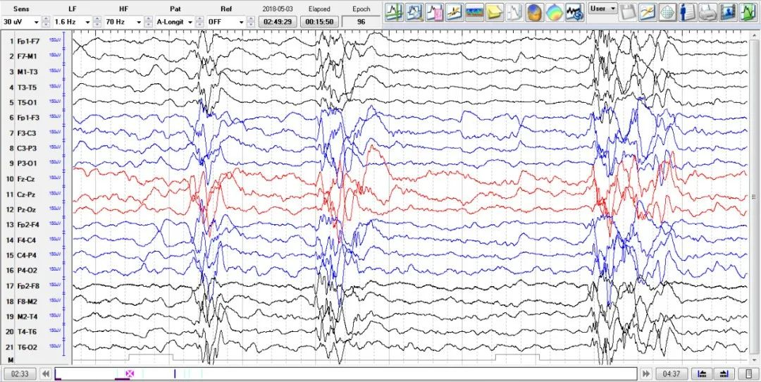 多种癫痫发作方式,视频脑电图监测中记录到强直发作,失张力发作,强直