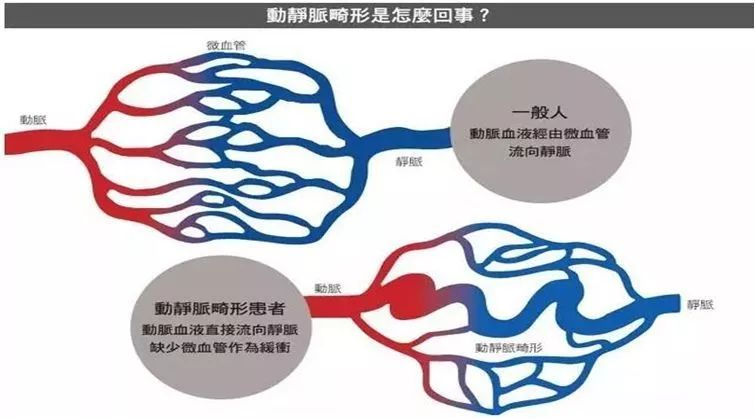 脑血管畸形,是保守?还是手术?