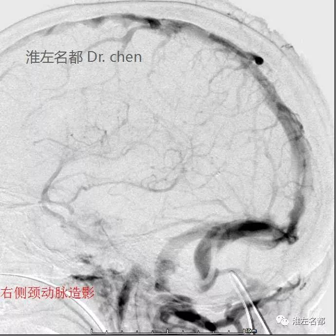 右侧颈动脉dsa(静脉期)侧位: 大脑内静脉,大脑大静脉和直窦未见显影