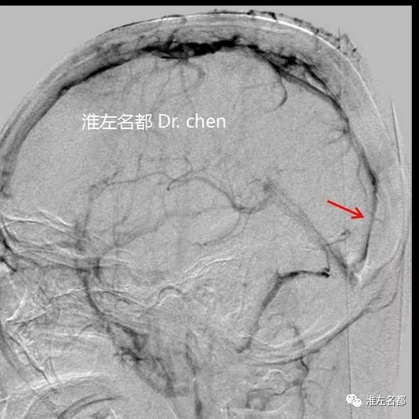 表现为恶性颅高压脑静脉窦血栓血管内机械介入再通治疗