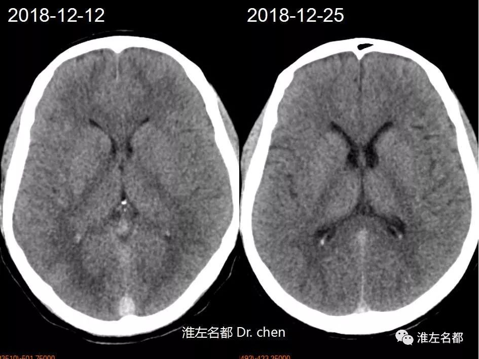 ct平扫:与入院时ct比较,脑水肿显著改善,侧脑室较前明显增大.