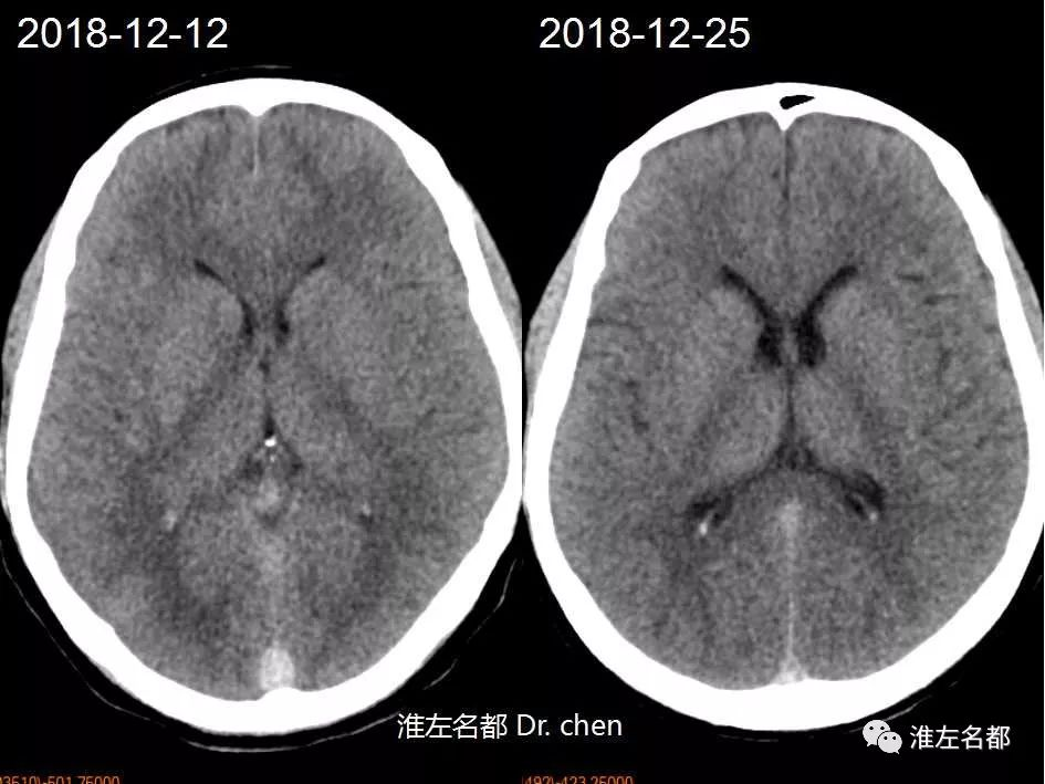 ct平扫:与入院时ct比较,脑水肿显著改善, 侧脑室较前明显增大.