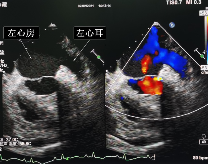 经食道三维超声:左心房和左心耳内可见云雾状回声,血栓前期考虑.