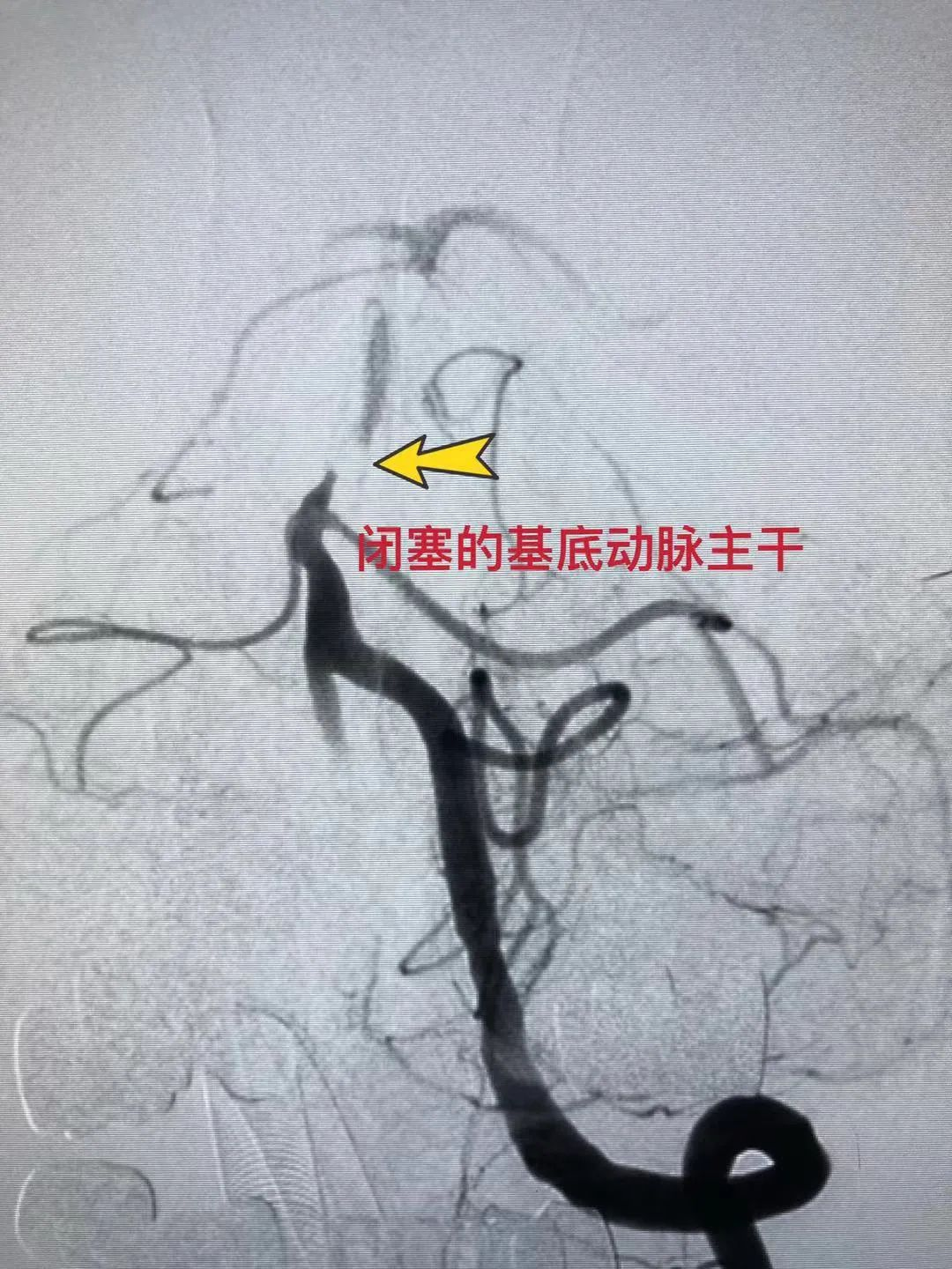 许伟东:sacspeed球囊用于急性基底动脉闭塞开通术一例