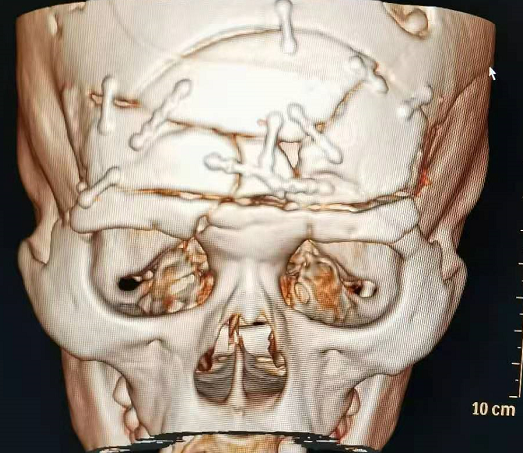 带蒂骨瓣及骨膜瓣行颅底骨性及膜性重建,治疗脑脊液漏