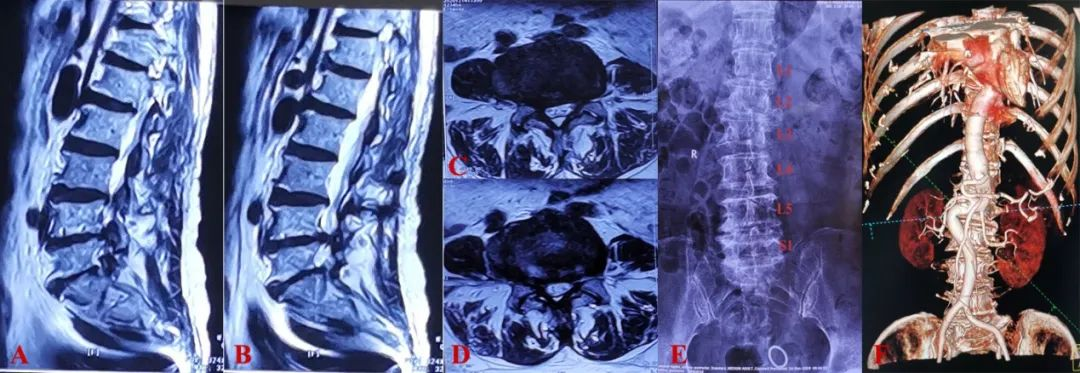 (a,b:腰髓mri t2相矢状位;c,d: 腰髓mri t2相轴位-腰5/骶1水平;e:腰椎