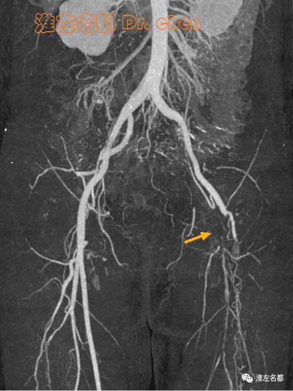 主动脉和下肢动脉cta:左侧股动脉闭塞(橙箭)