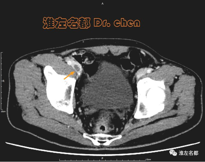 增强ct静脉期:右侧髂静脉血栓充盈缺损(橙箭)