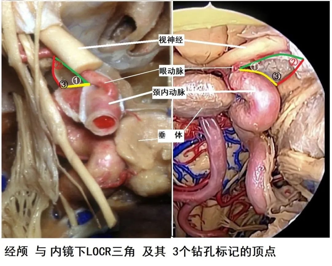 前床突磨除技术(下篇)---我的手术学习笔记系列