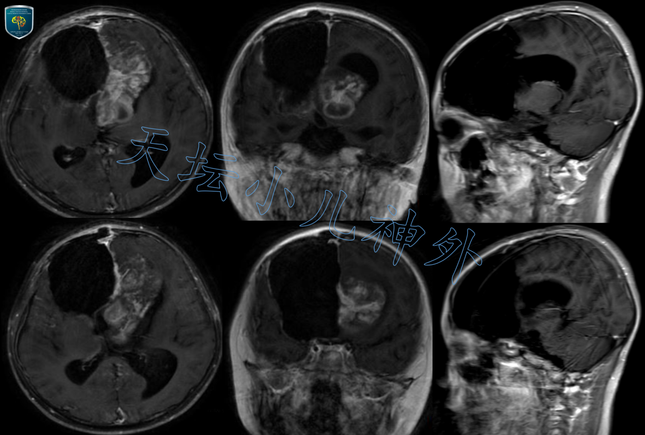 宫剑教授病例分享（十六）：儿童型脑膜瘤的外科治疗 - 脑医汇 - 神外资讯 - 神介资讯