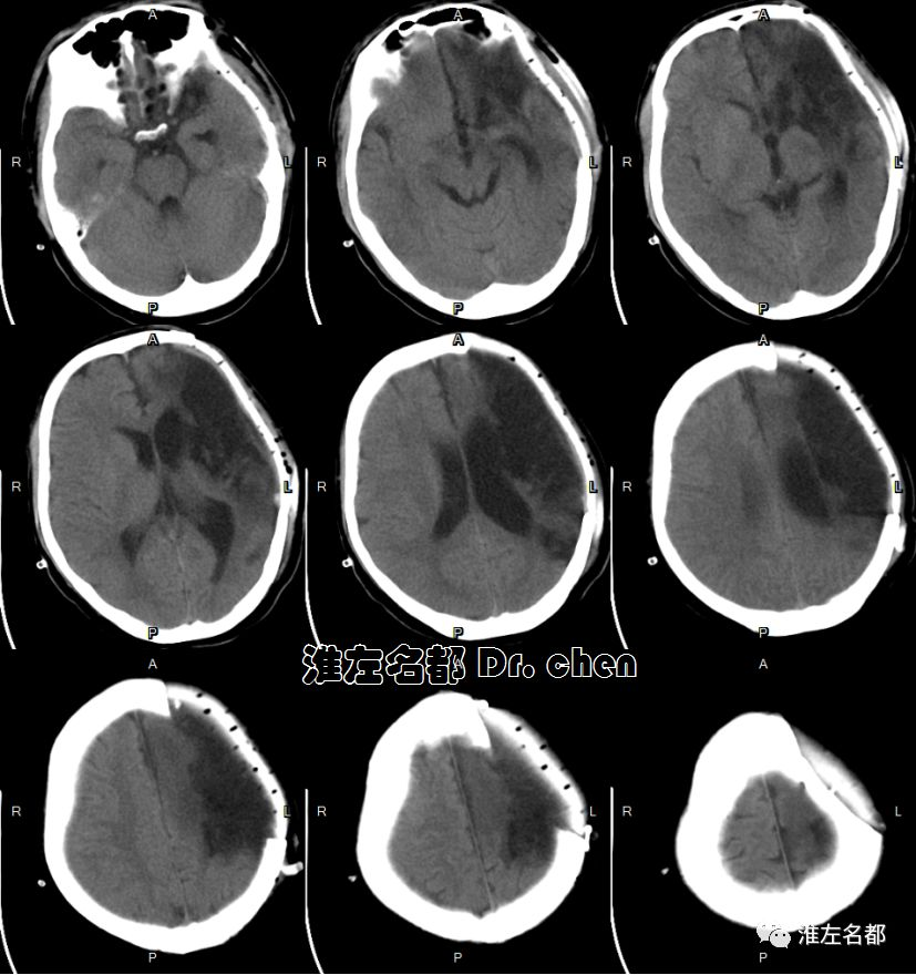 头颅ct平扫:左侧半球大面积陈旧性梗死软化灶,左侧颅骨修补术后.