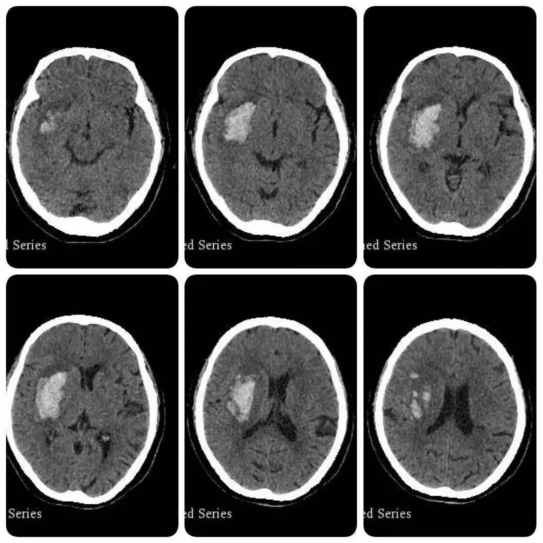 患者入院时ct,显示右侧基底节血肿,不规则,血肿上部少许血肿渗出液