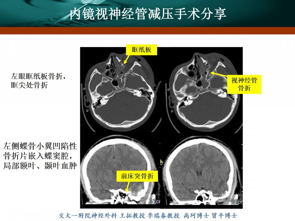 王拓教授团队:内镜视神经管减压手术分享