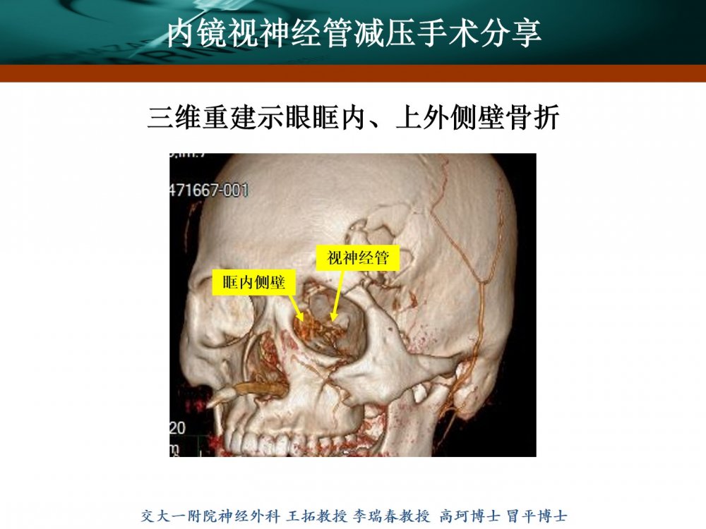 王拓教授团队:内镜视神经管减压手术分享