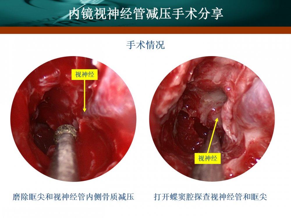 王拓教授团队:内镜视神经管减压手术分享