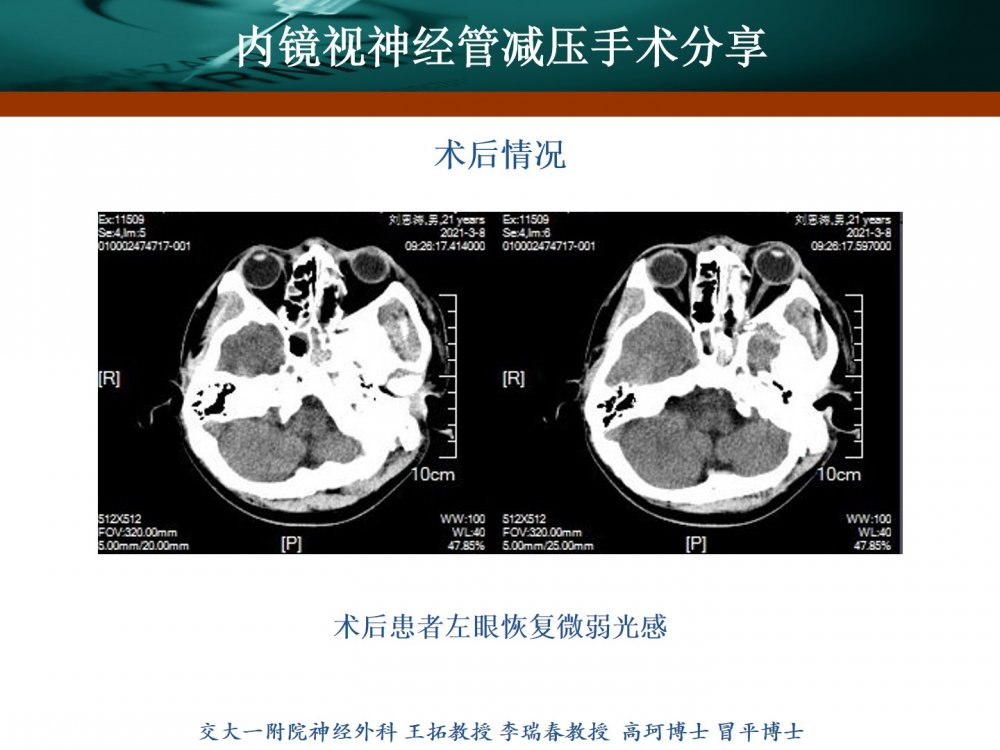 王拓教授团队内镜视神经管减压手术分享