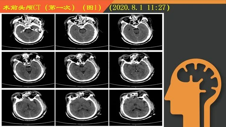 复杂重型开放性颅脑损伤一例