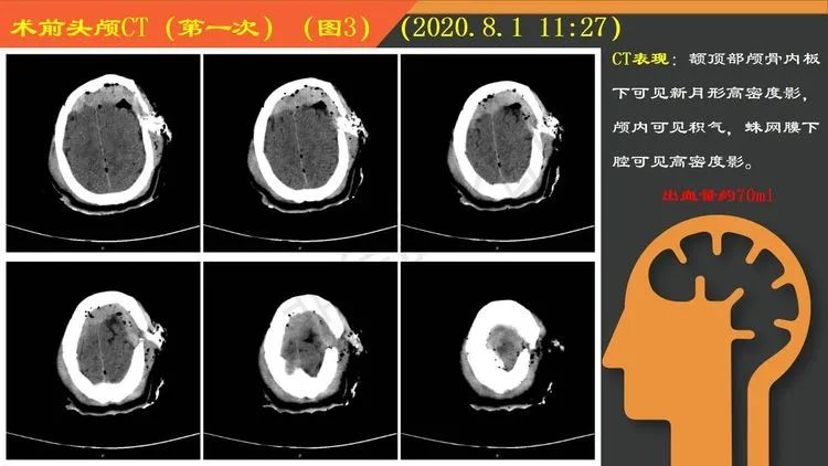 复杂重型开放性颅脑损伤一例