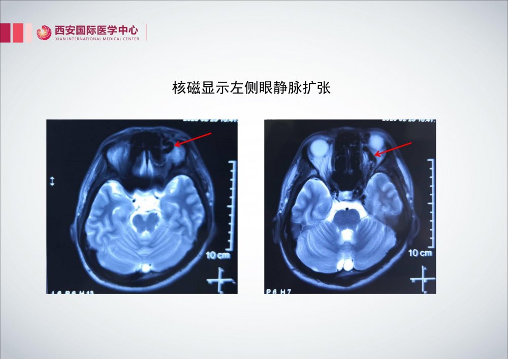 颈内动脉海绵窦瘘治疗2例 脑医汇 神外资讯 神介资讯