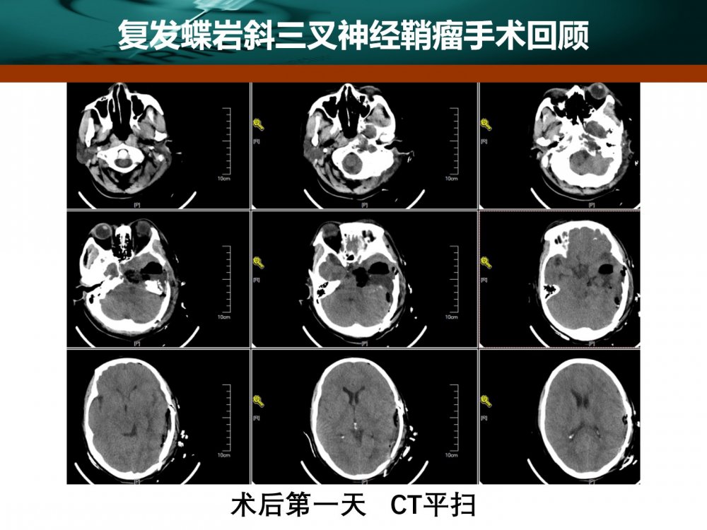 王拓教授团队:一例复发蝶岩斜三叉神经鞘瘤 的手术切除