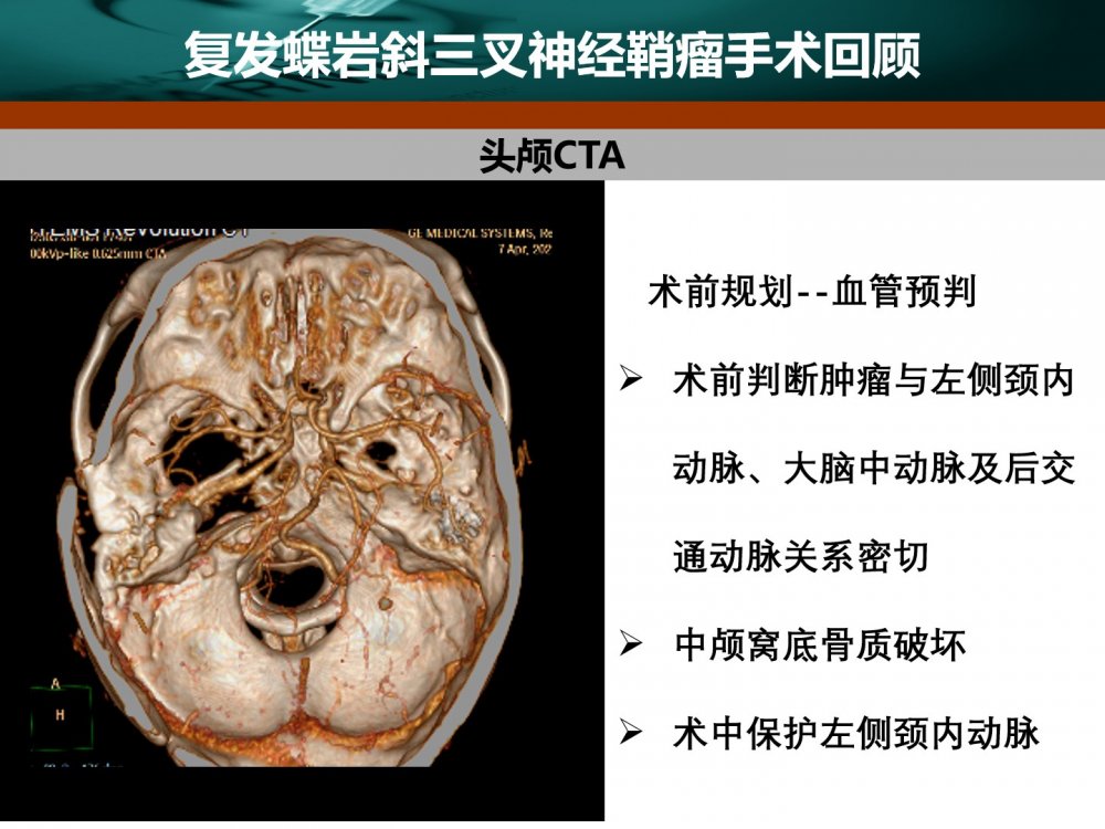 王拓教授团队:一例复发蝶岩斜三叉神经鞘瘤 的手术切除