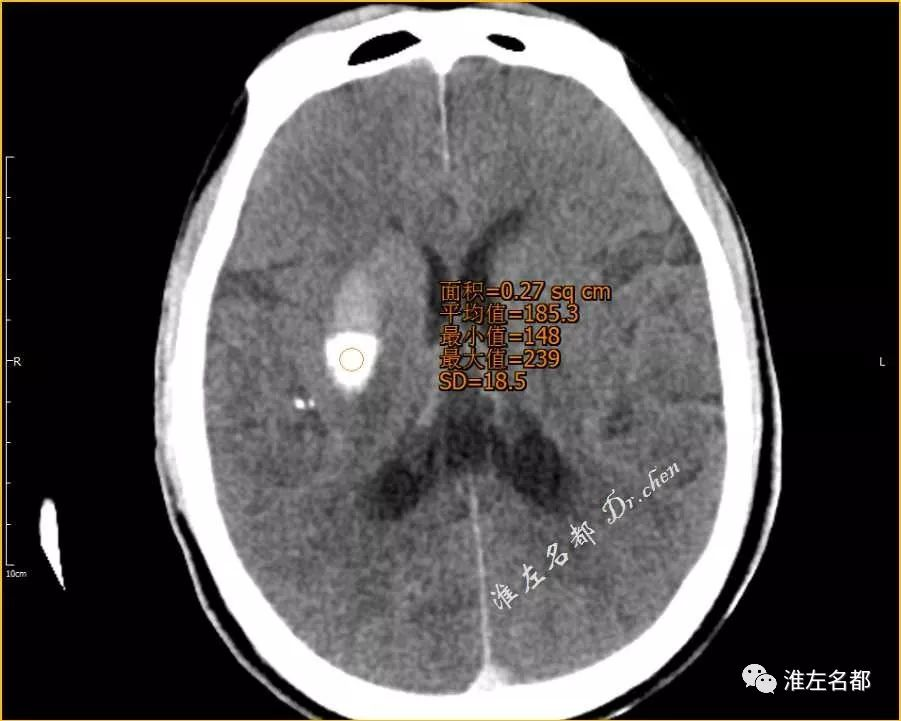 △术后即刻ct:右侧基底节区高密度的后半部分ct值 185hu