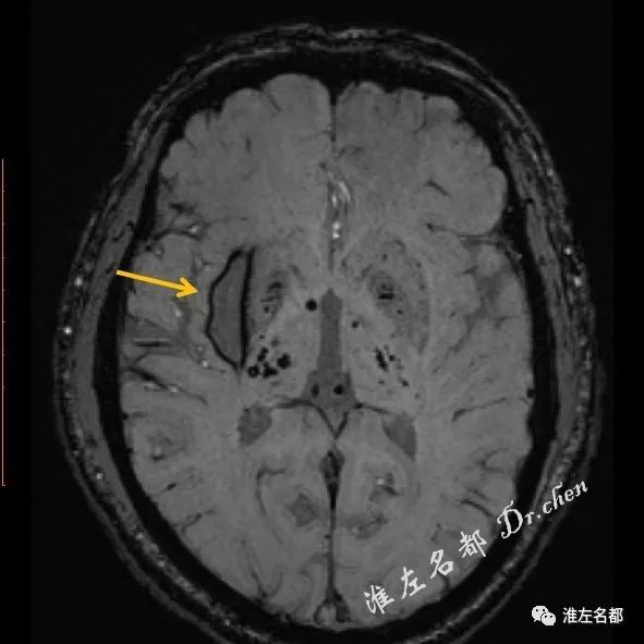 右侧基底节区软化灶边缘含铁血黄素沉着低信号(黄箭),双侧基底节和