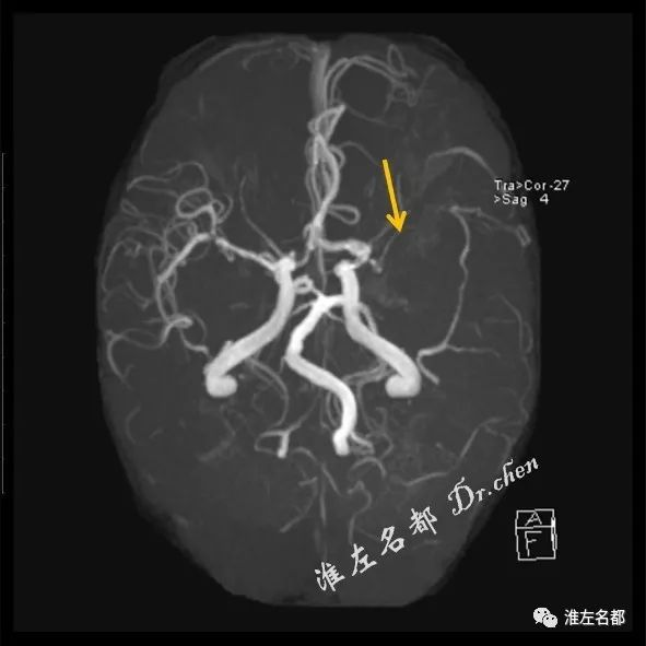 原发性脑出血为什么要行磁共振成像评估?