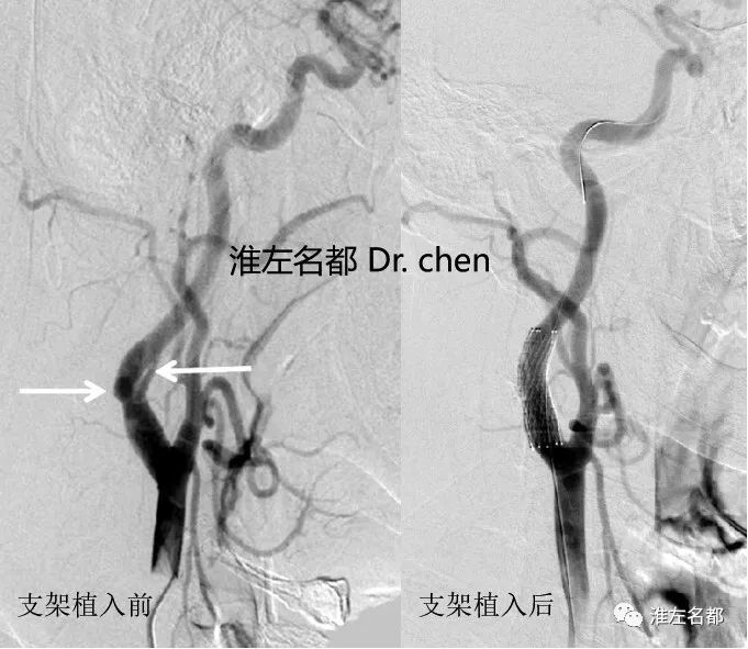 基于病理机制的颈动脉夹层支架治疗:适应证,时机及