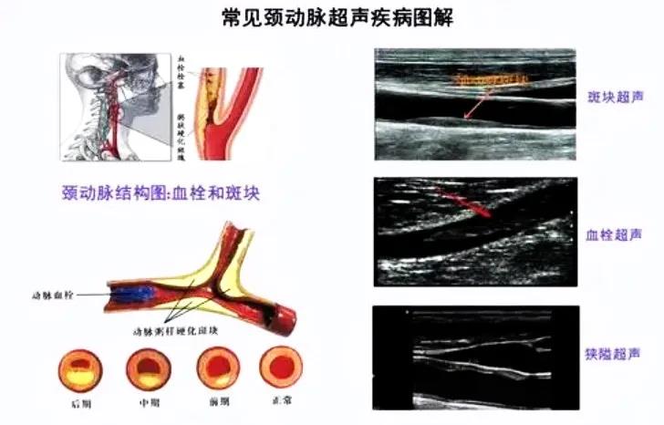 目前对颈动脉狭窄的检查手段主要有颈部b超,头颈mra,以及颈部斑块核磁