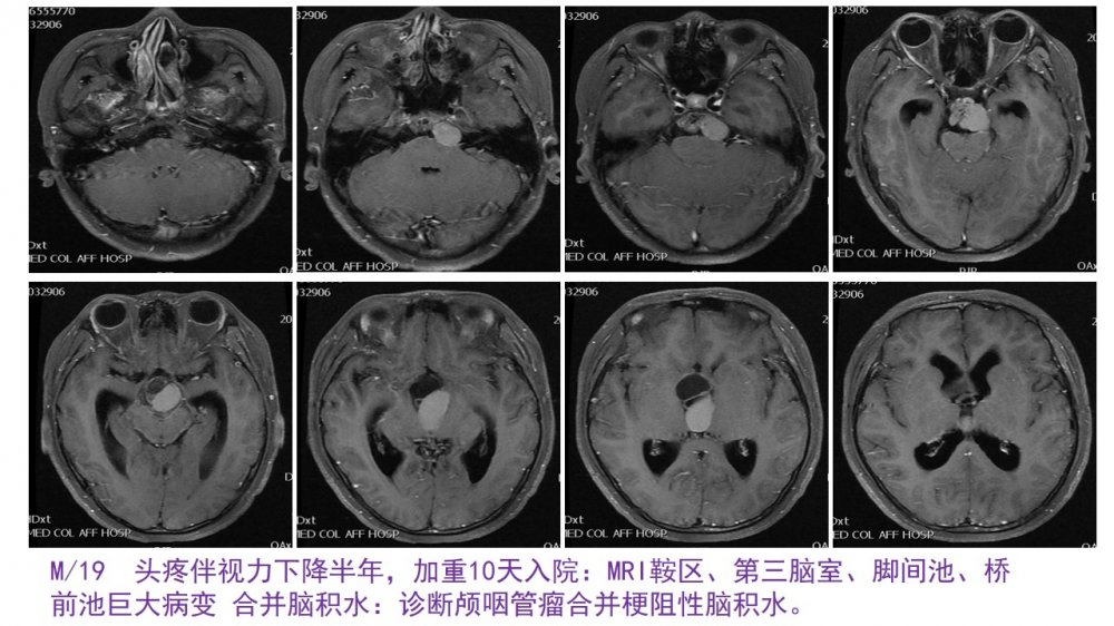 肖顺武教授神经内镜扩大经鼻入路切除鞍内鞍上第三脑室脚间池桥前池颅