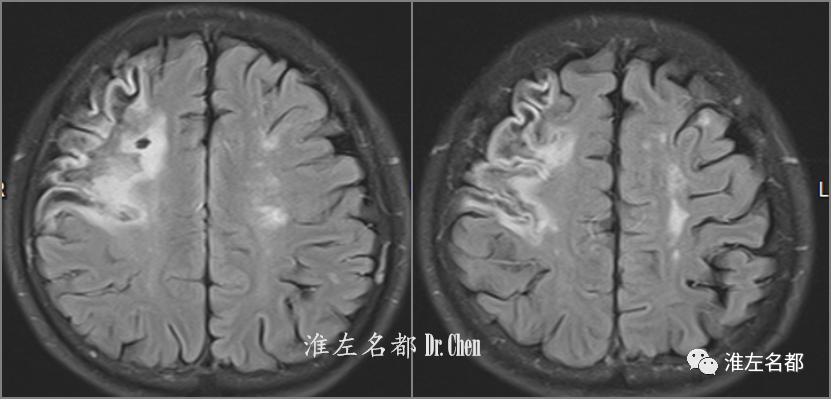 flair:右侧额叶陈旧性梗死.