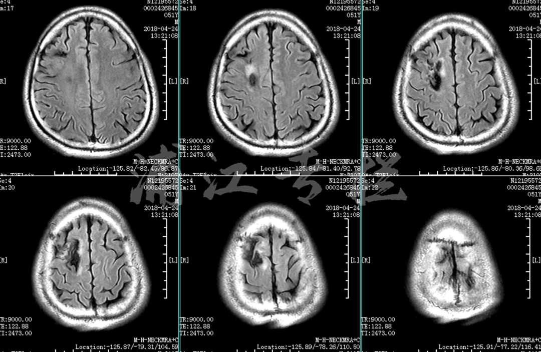 图10. mri可见右侧额叶软化灶.