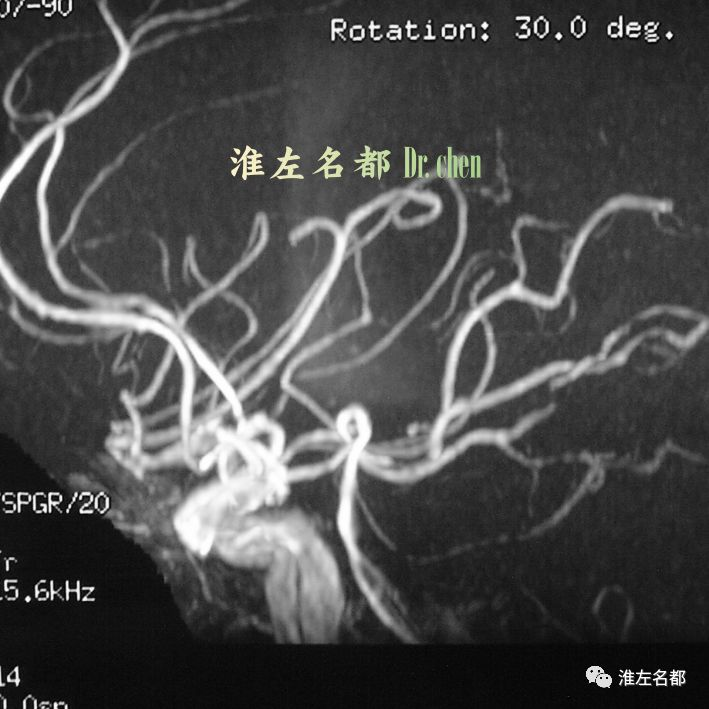 神经血管影像速阅32基底动脉夹层和进展性双侧脑桥梗死