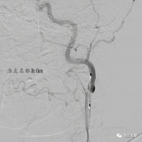 颈动脉蹼支架治疗(合并对侧颅内前循环粥样硬化慢性