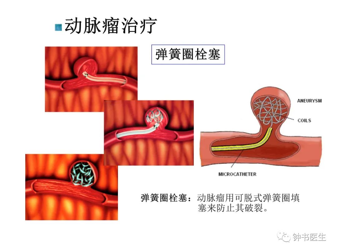 钟书教授专栏丨颅内动脉瘤概论