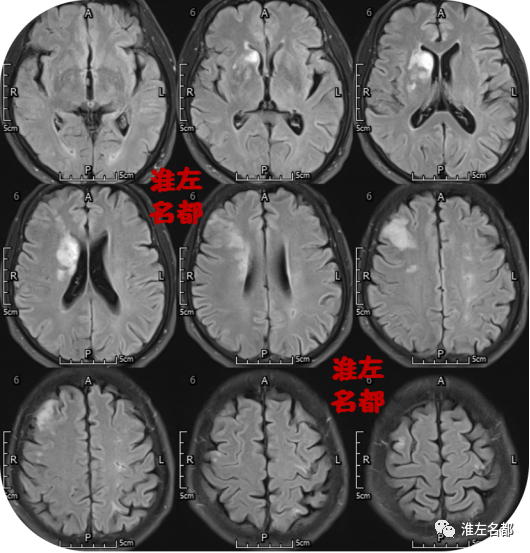脑dwi和flair:右侧额叶,放射冠区和基底节区多发急性梗死.