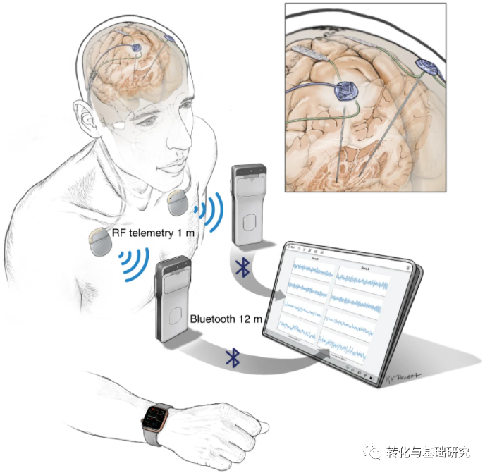 个性化治疗帕金森加州大学独创植入式脑电波记录仪