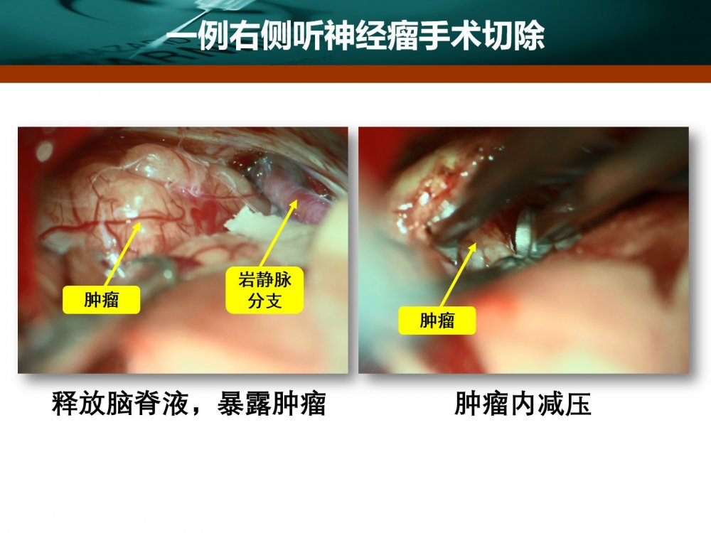 王拓教授团队一例右侧听神经瘤手术切除