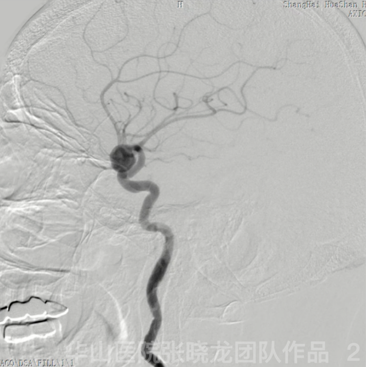 Stent Assisted Coiling Of An Mca Aneurysm