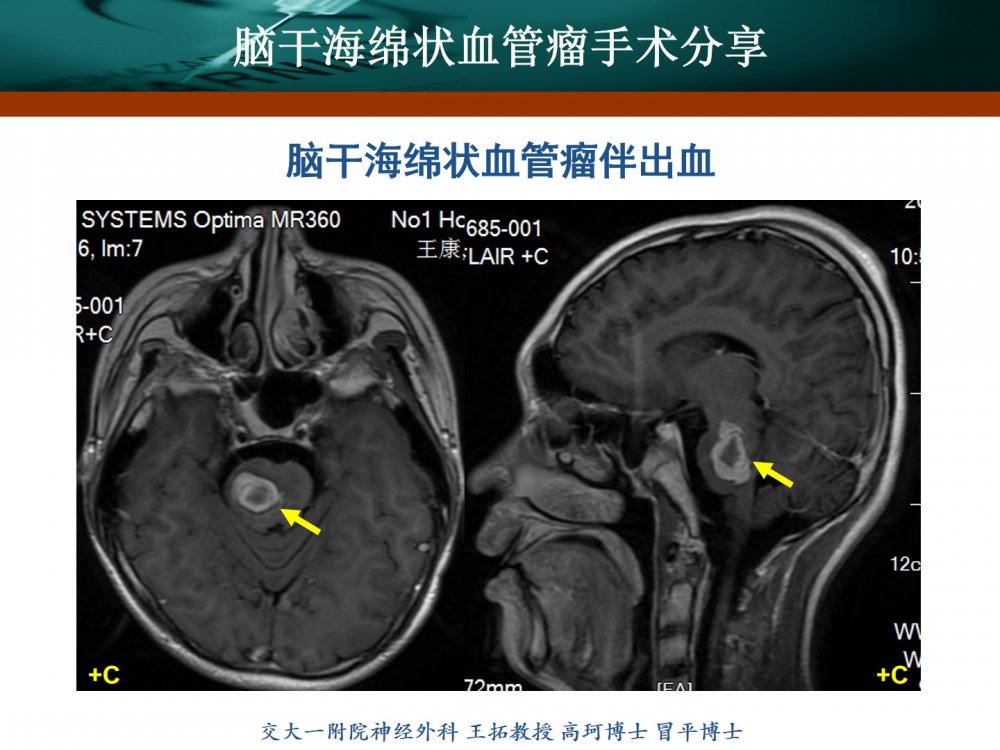 脑干海绵状血管瘤手术分享