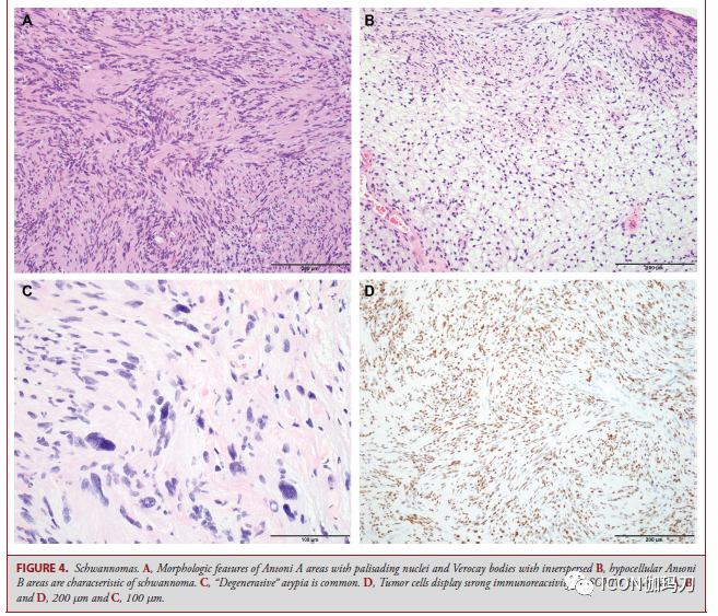神经鞘瘤的细胞antoni a区有栅栏状的细胞核和verocay小体,并散布着