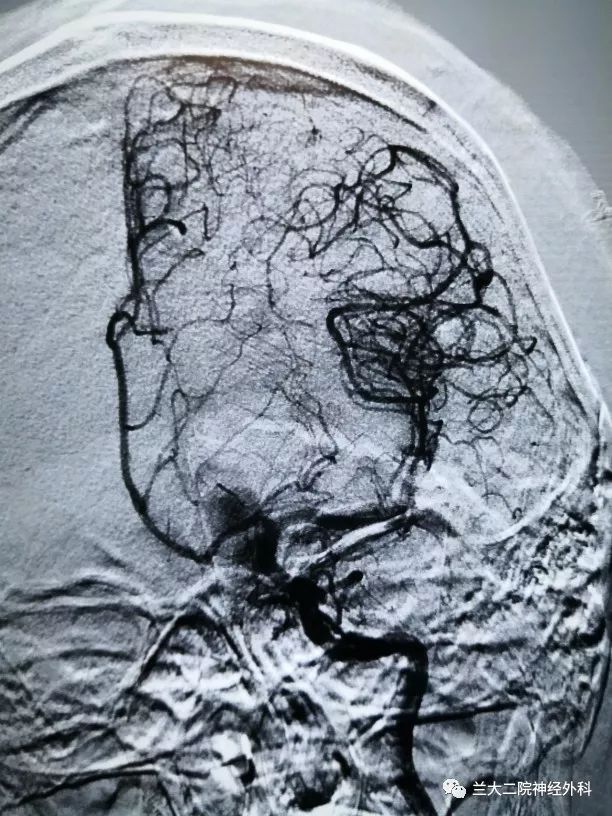 前颅底硬脑膜动静脉瘘栓塞术一例