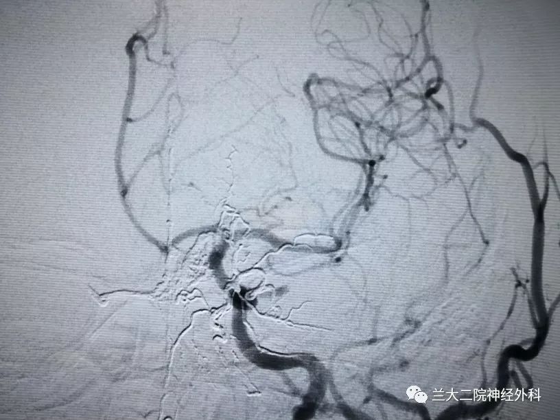 前颅底硬脑膜动静脉瘘栓塞术一例